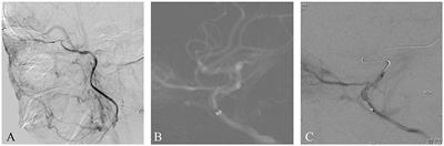 Case Report: Trigeminocardiac Reflex in Endovascular Recanalization of Intracranial Internal Carotid Artery Occlusion